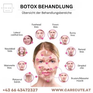 Botox Wien