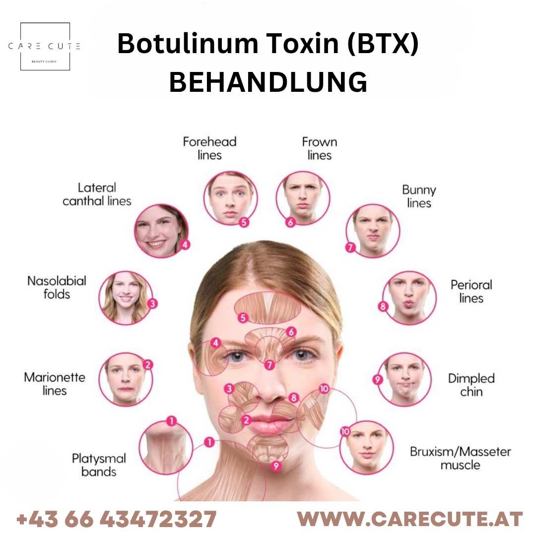 Botulinum Toxin (BTX) Botulinum Toxin (BTX)